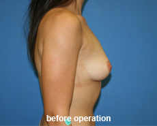 plastic-surgery-breast-augmentation